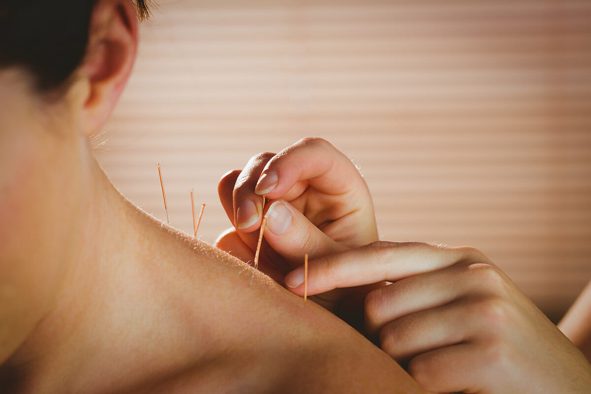 What to Expect From Acupuncture
