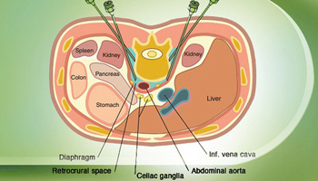 Celiac Plexus Block