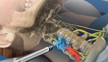 Cervical Epidural Steroid