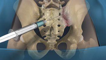 Sacroiliac Joint Injection