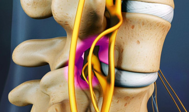 Spinal Stenosis Pain