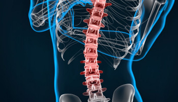 Vertebroplasty Treatment